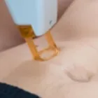 メンズ脱毛